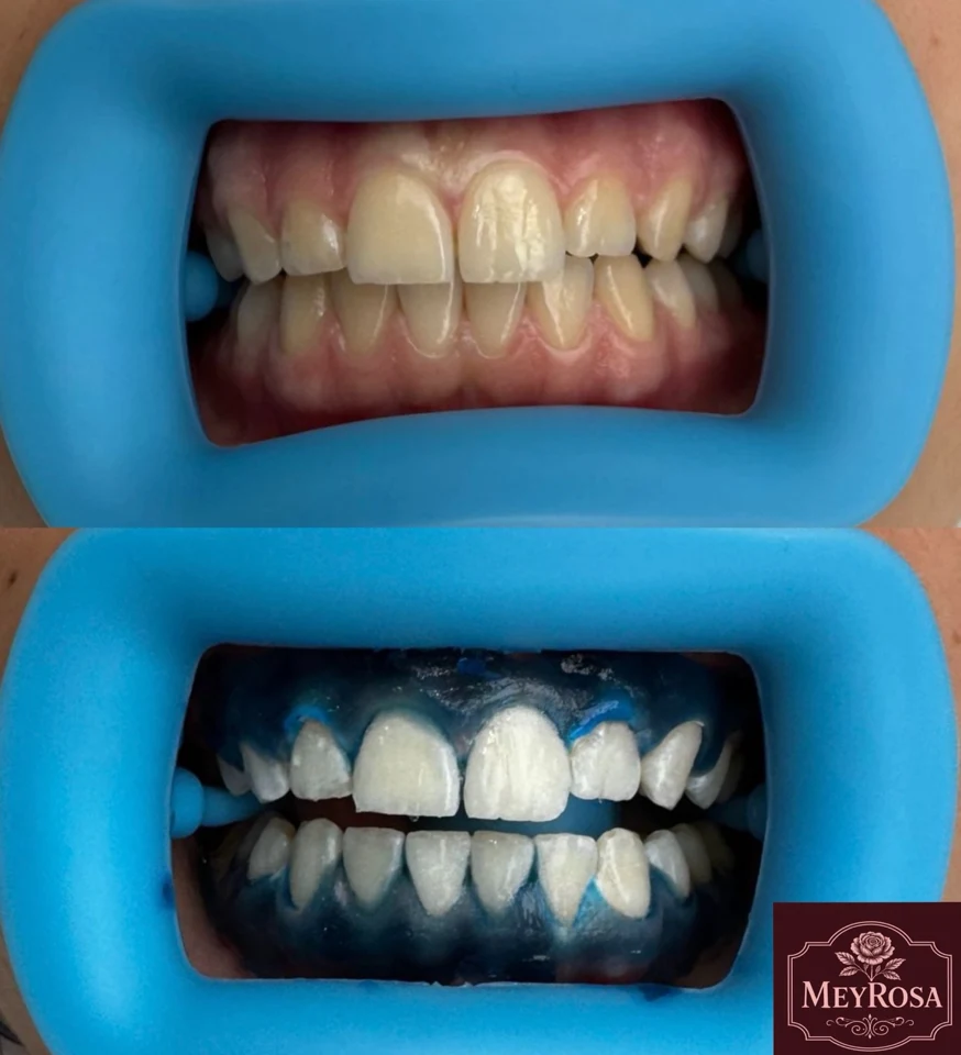 Meyrosa — smile 3